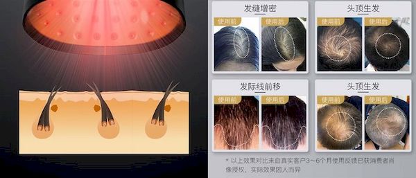 Xiaomi lançou um boné que promete reverter a perda de cabelo em 12 semanas